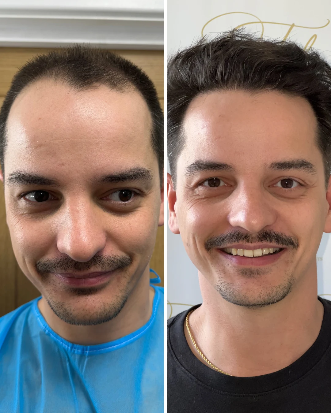 Before and after hair restoration result, patient one