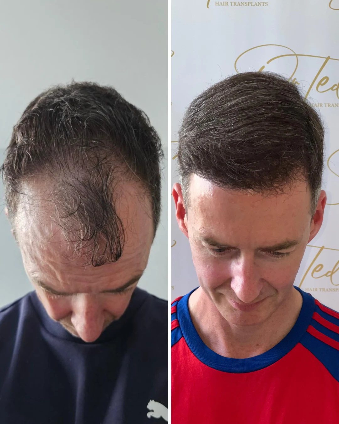 Before and after hair restoration result, patient two