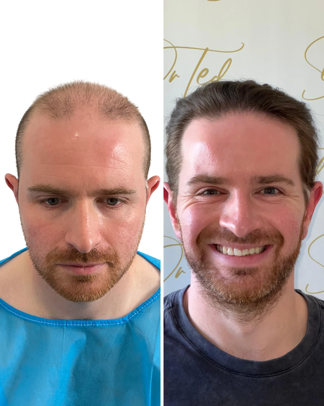 Before and after hair restoration result, patient three