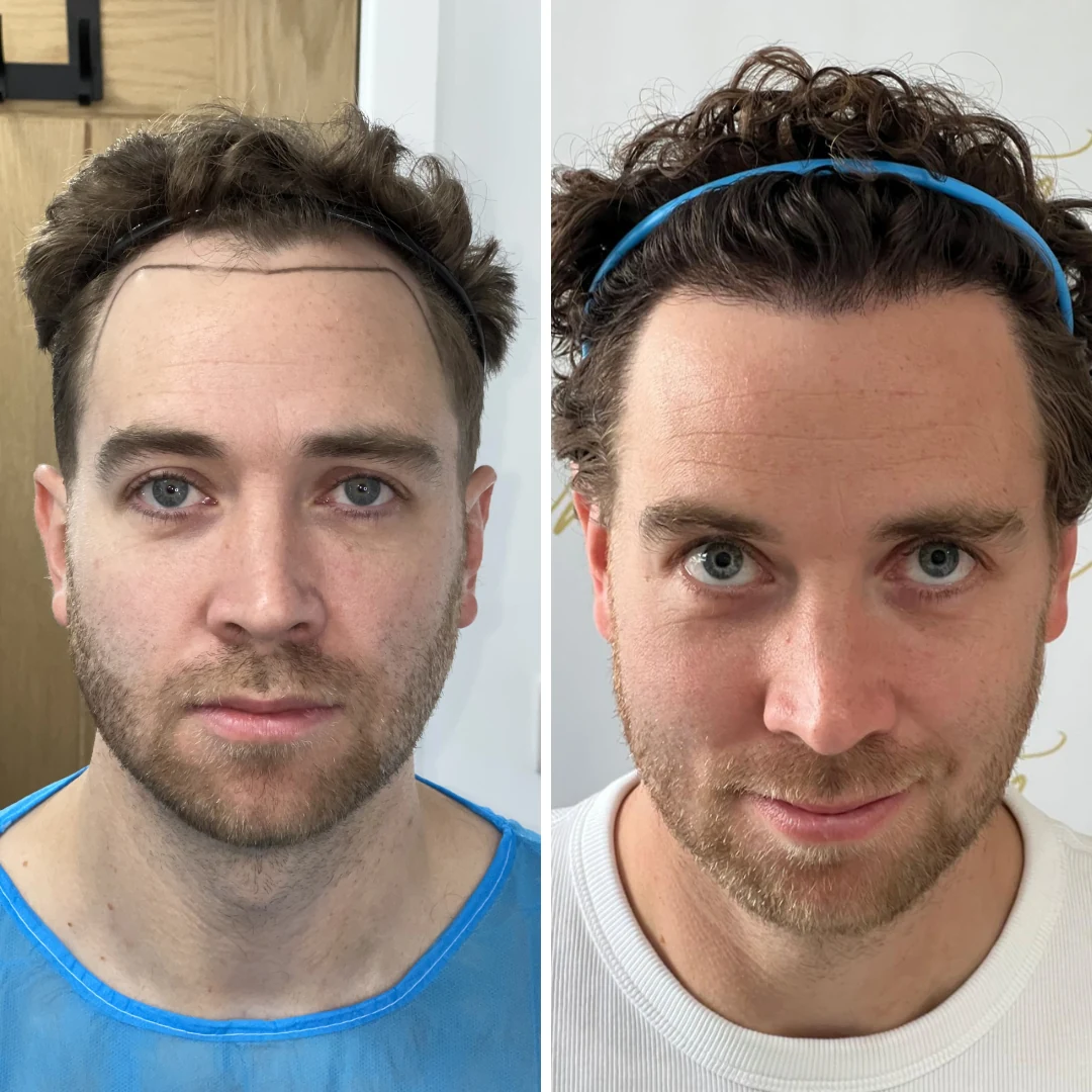 Before and after hair restoration result, patient four