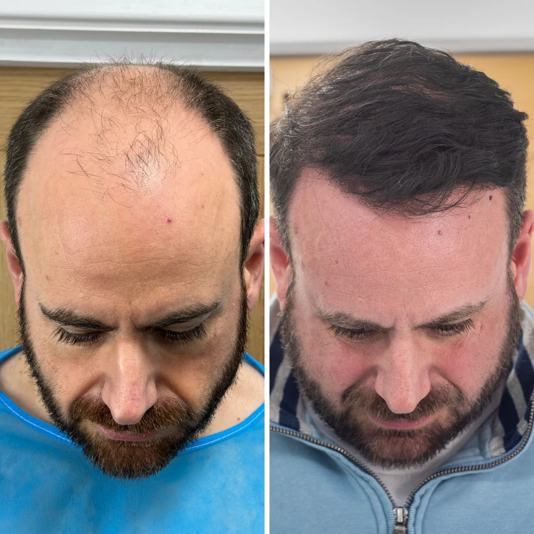 Before and after hair restoration result, patient five