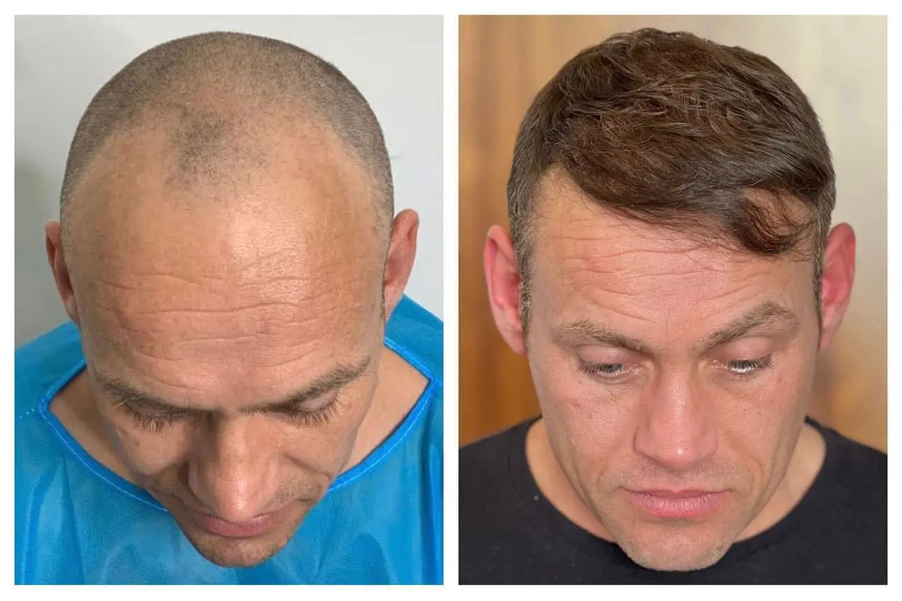 Before and after hair restoration result, patient one