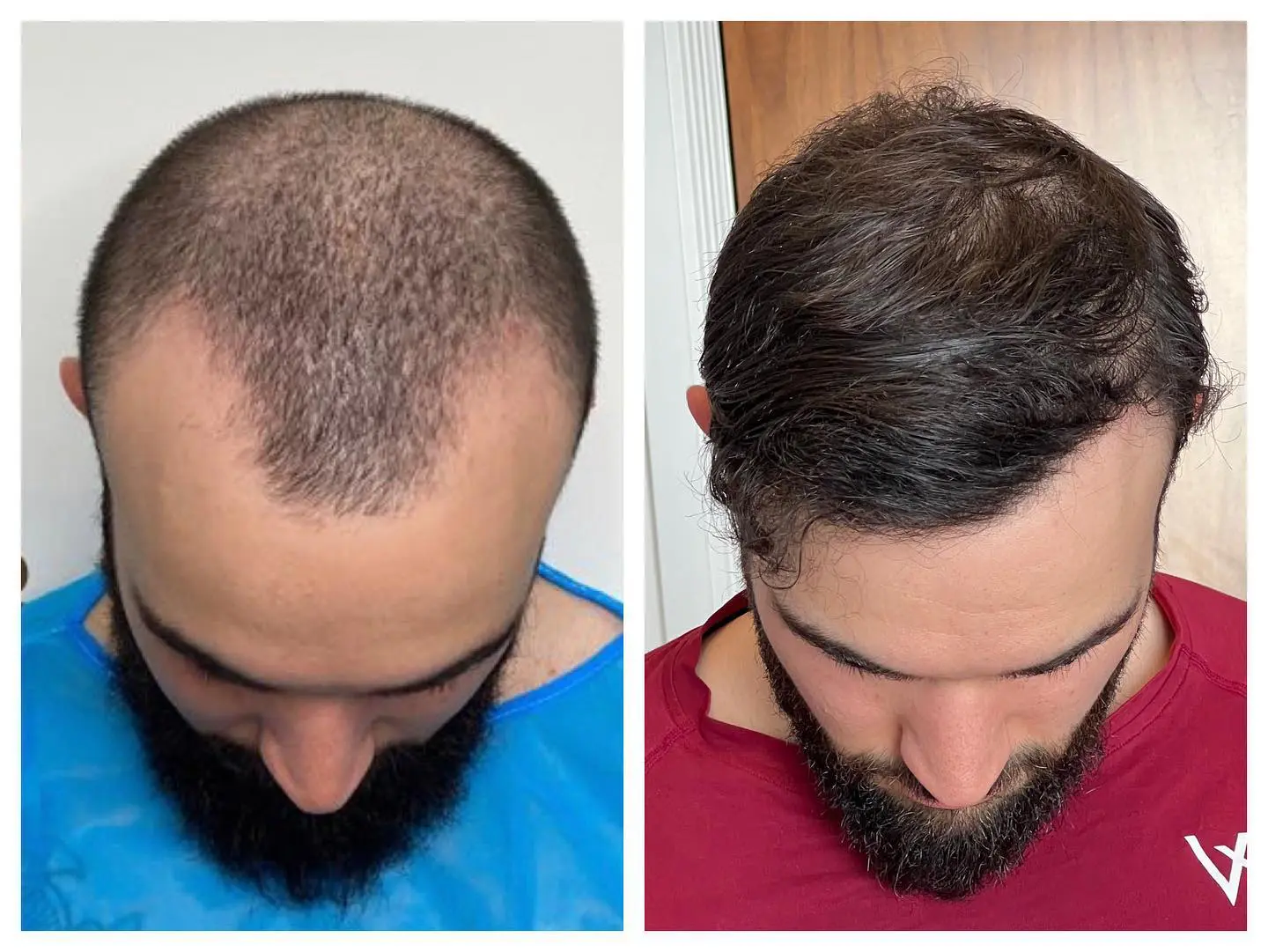 Before and after hair restoration result, patient two