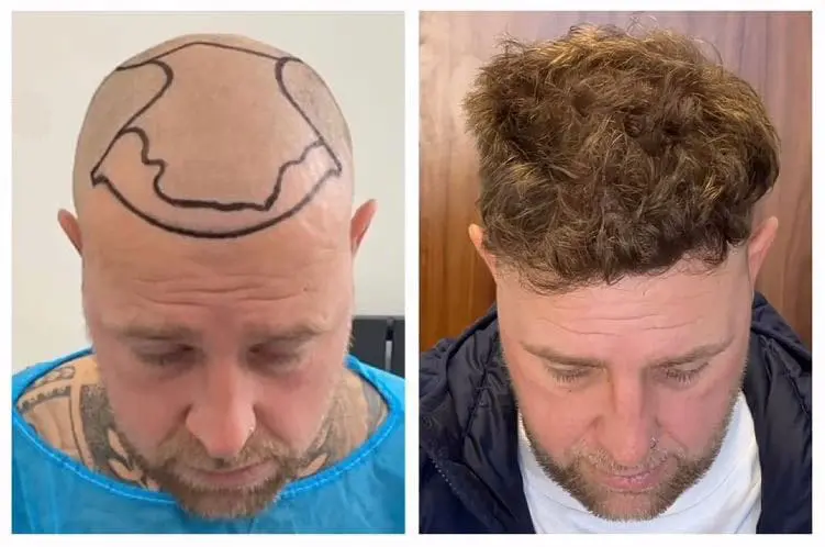 Before and after hair restoration result, patient three