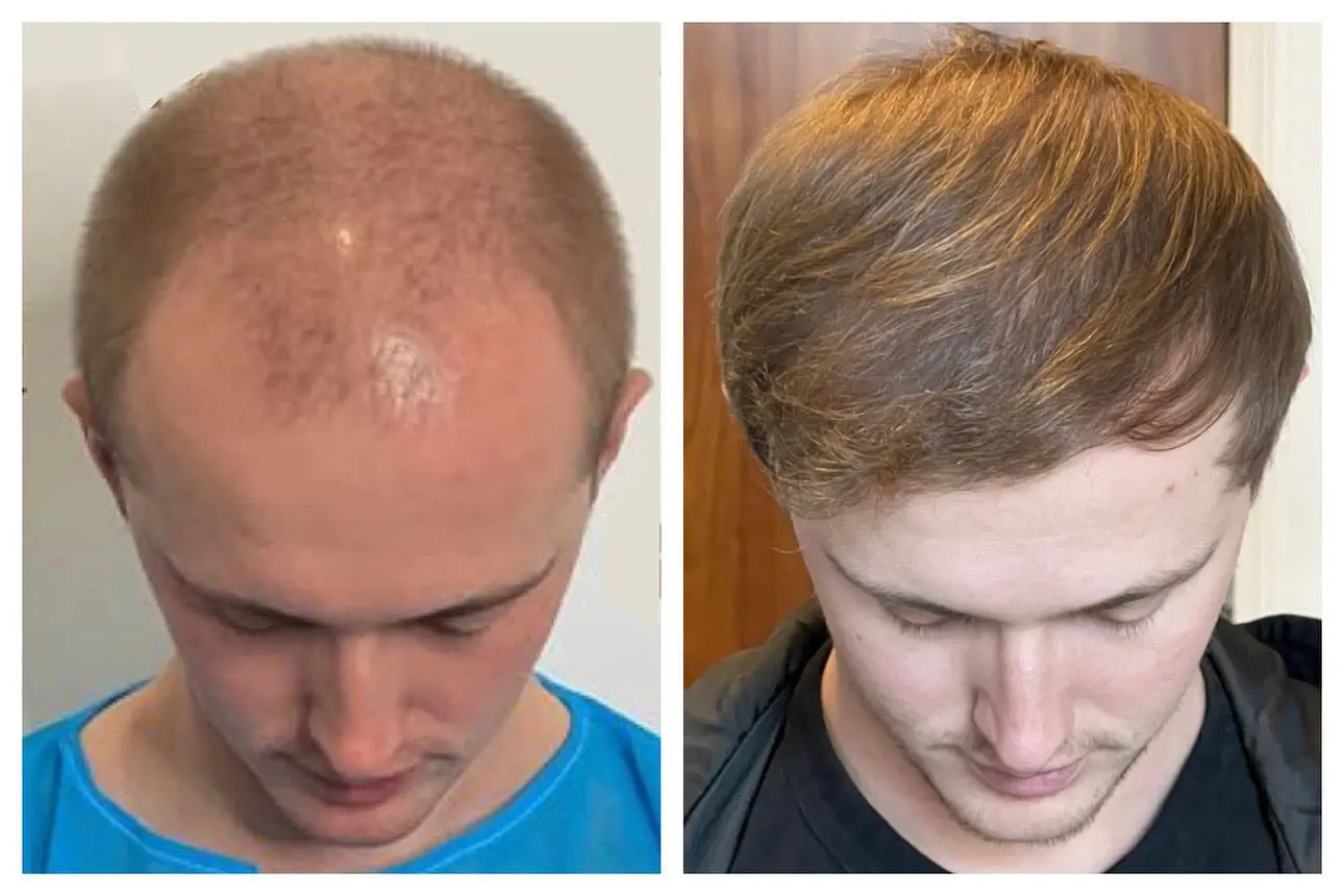 Before and after hair restoration result, patient four