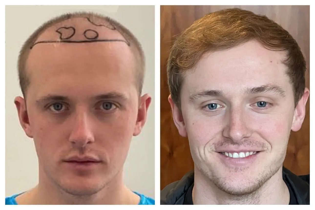 Before and after hair restoration result, patient five